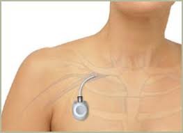INTRAVENOUS PORT INTRAVENOUS PORT